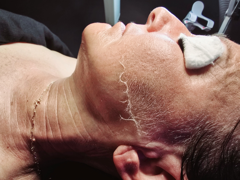 Dermaplaning Facial
