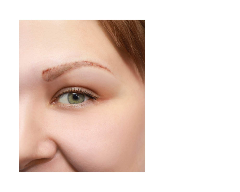 REMOVAL Tattoo /  EMERGENCY Removal