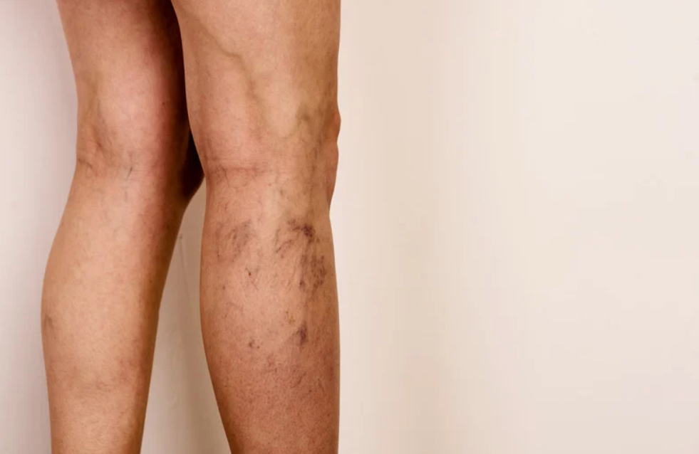 Calf Stretchmark Camouflage (Both)