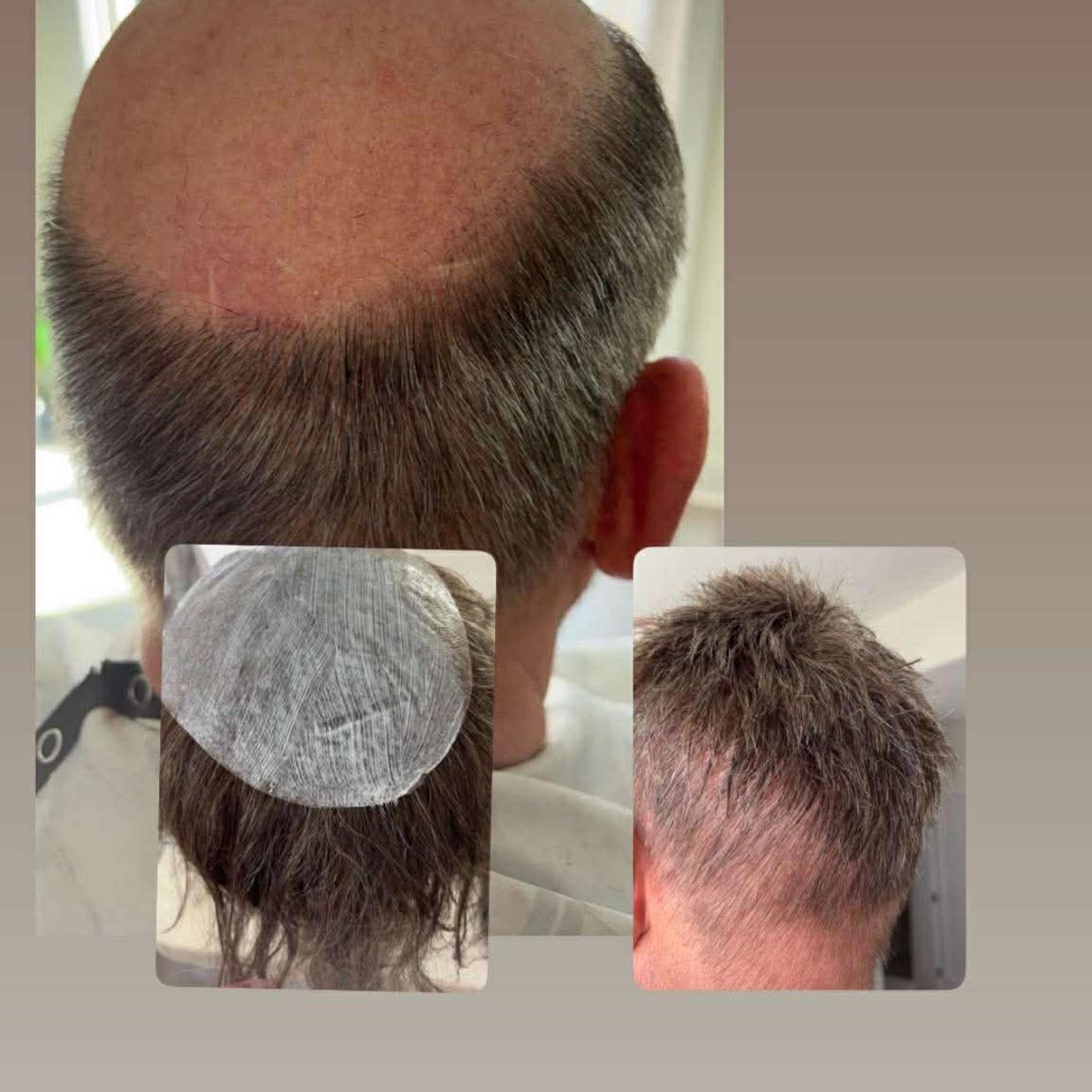 Hair Replacement Refresh at Allure ICT in Wichita, KS