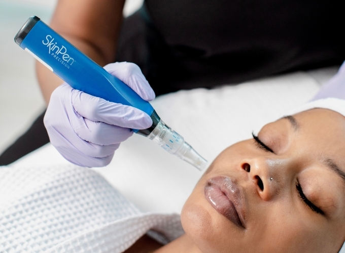 Microneedling – Face Only at Sunkissed Beauty Co. in Vinton, IA