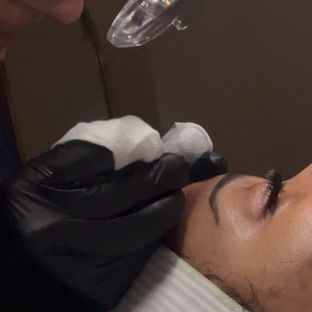 Acne Treatment at Complexion Therapy in Kennewick, WA