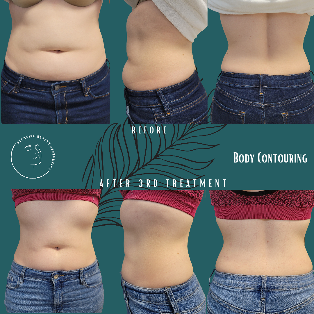 Body Contouring