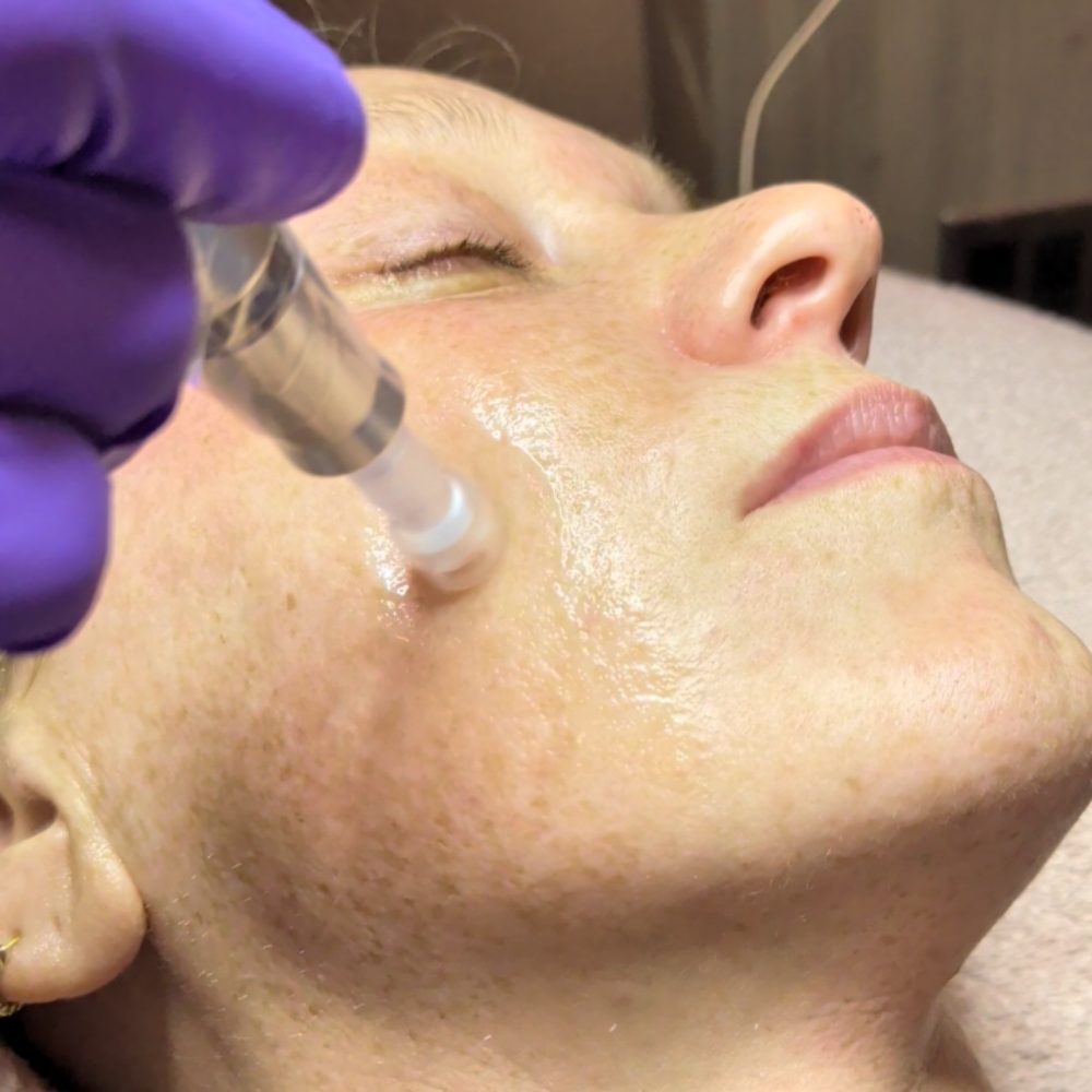 Microneedling at Esthetics With Candise in Omaha, NE