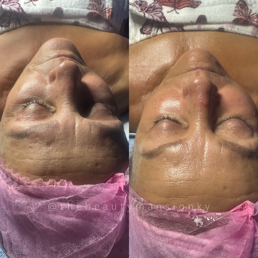 Non Surgical Facelift