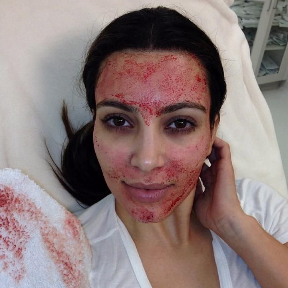 Vampire Glow PRP Renewal at Skin Deep Beauty Spa in Sulphur, LA