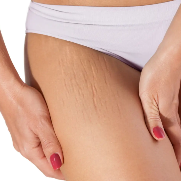 TCA Peel - Body at Sophiesticated Esthetics in Miami, FL