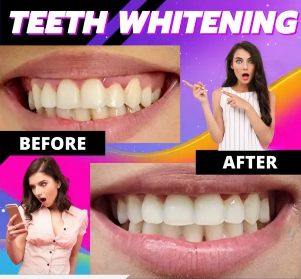 Teeth Whitening at Beauty2you in Visalia, CA