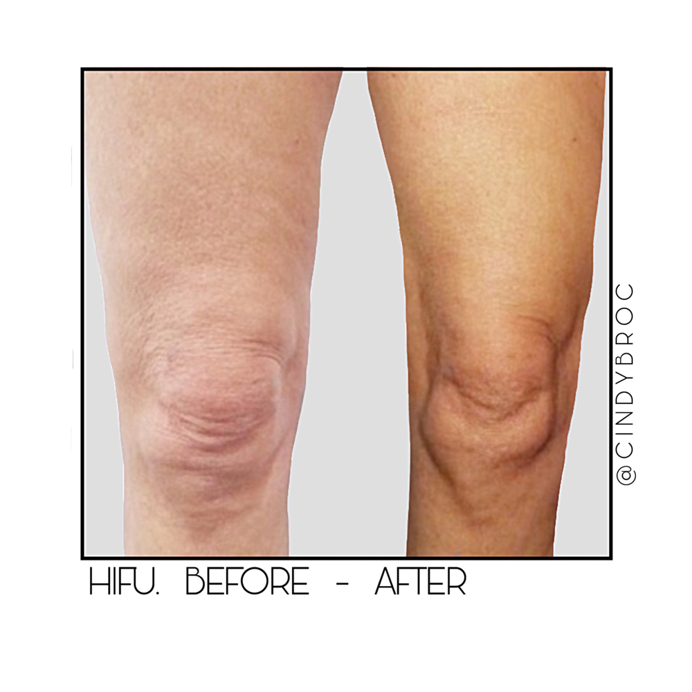 HiFu Treatment Legs -Priced By Area