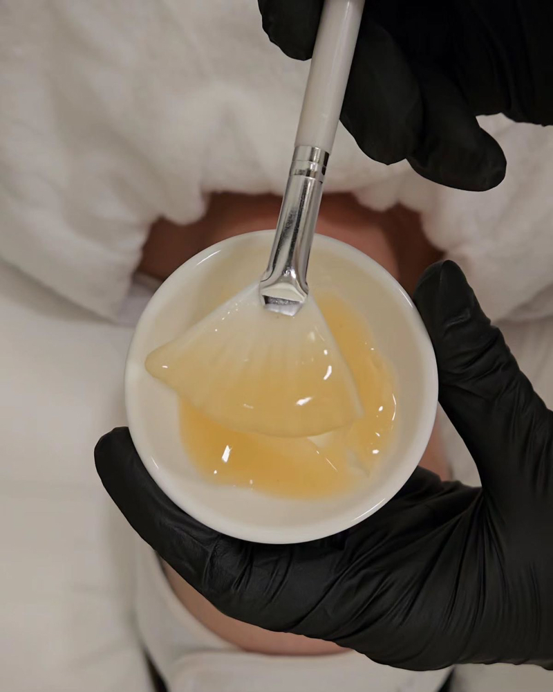 Chemical Peel at Alchemy Aesthetics in Texarkana, AR