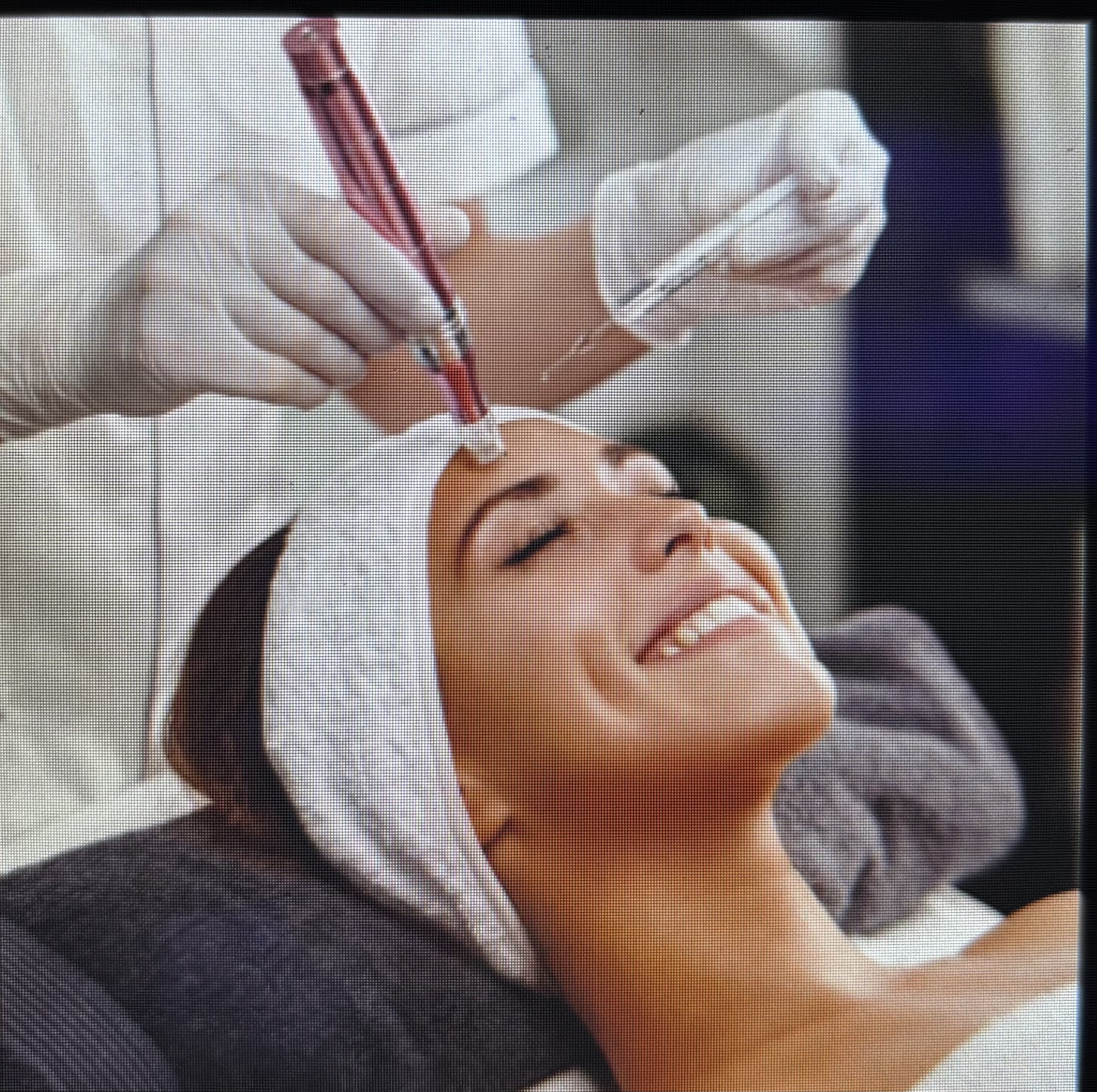 Microneedling