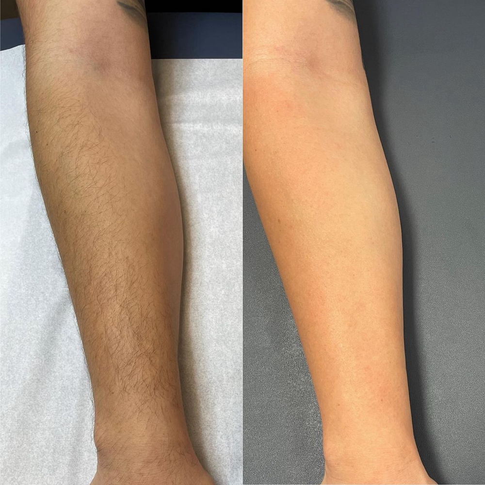 Half Arm Wax