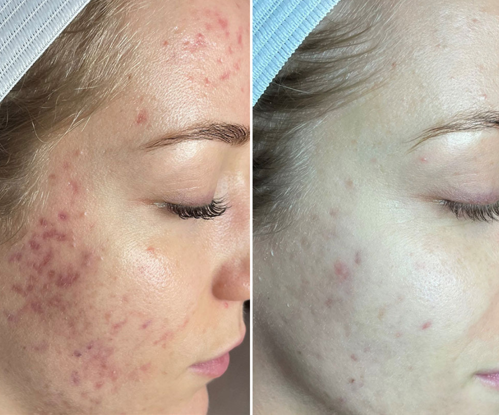 3 Microneedling Sessions