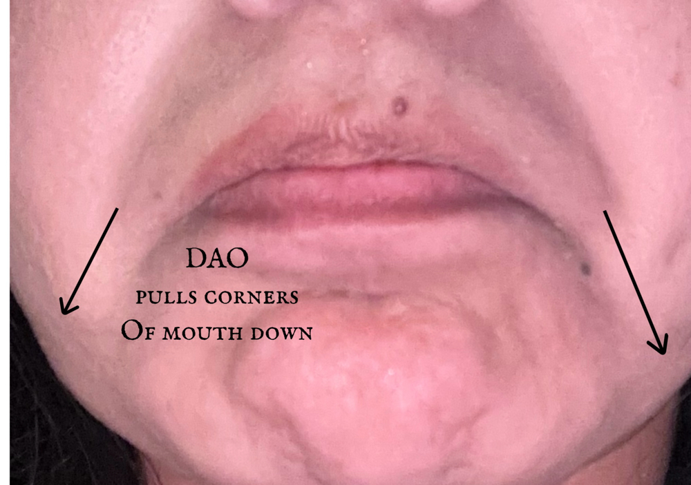 DAO - Frown Lip Lines - Xeomin