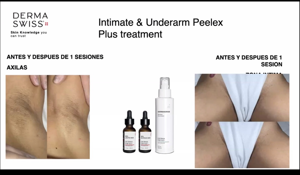 chemical peel