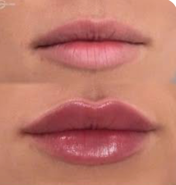 Needless Lip Filler 1 ML at Ash N Aura in Crofton, MD