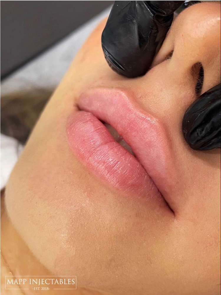 .5ML Micro-Needle (Only) at THE LIP FACTORY in Raleigh, NC