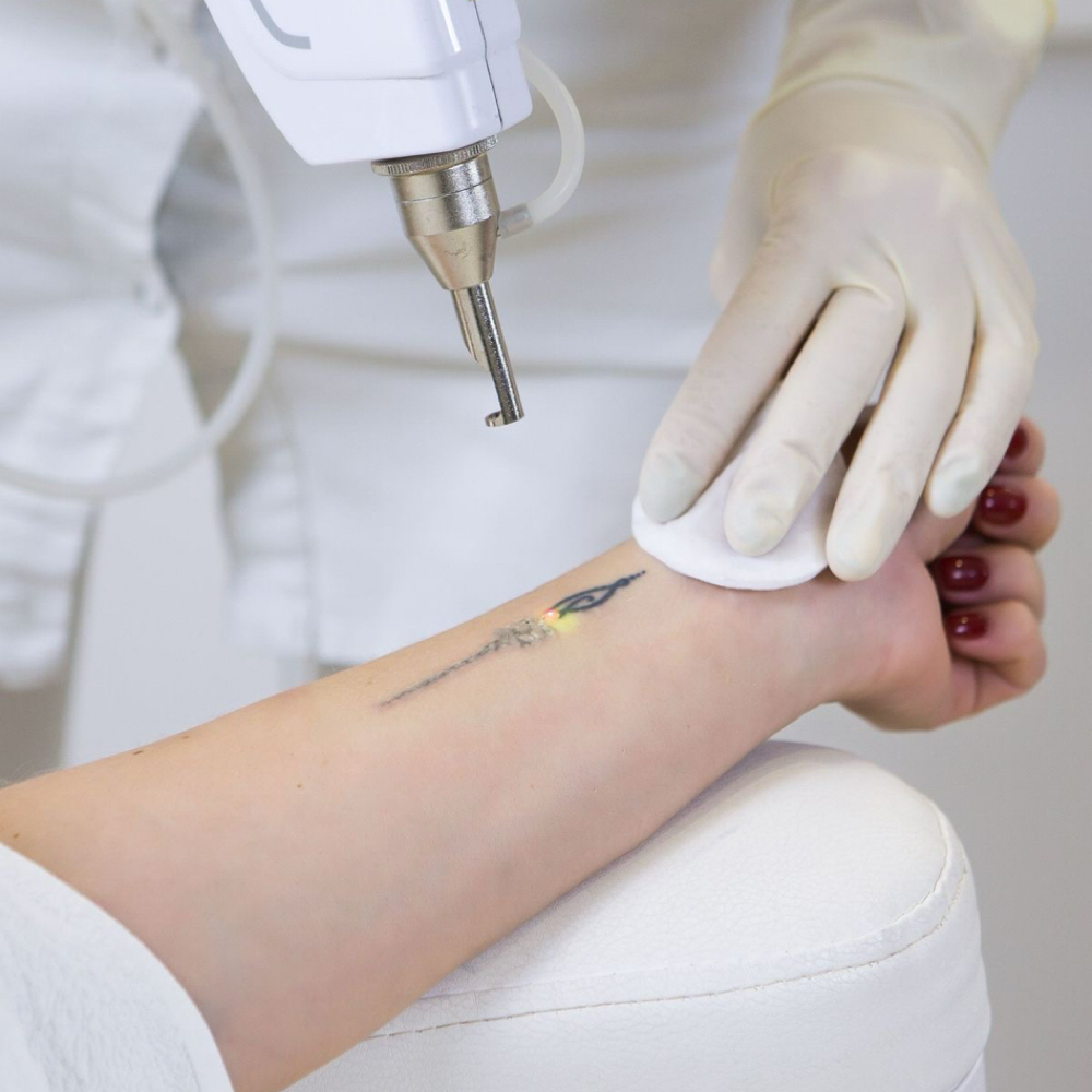 Tattoo Removal at Aurora Glow Aesthetics in Spring, TX