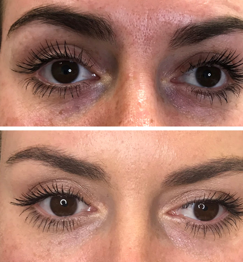 Under Eye Mesotherapy