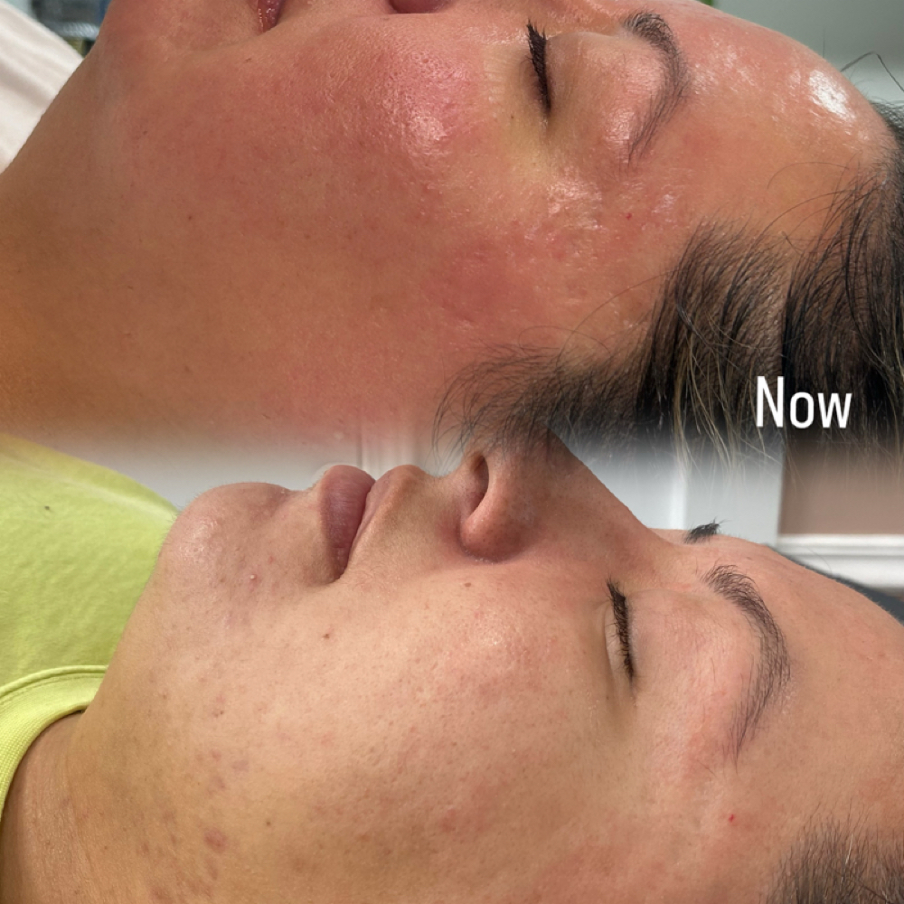 Lemon Honey Brightening Facial at Blu Topaz Esthetics in Aurora, IL