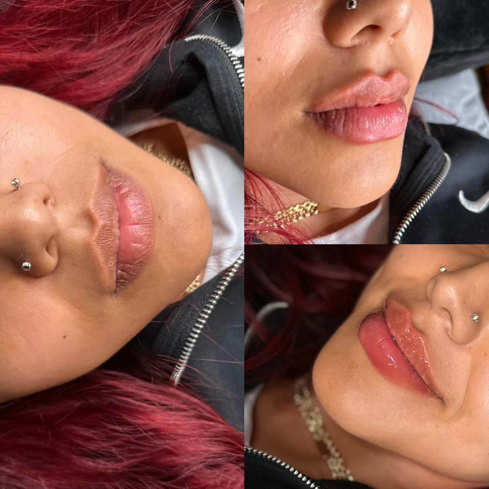 lip filler 0.5mL