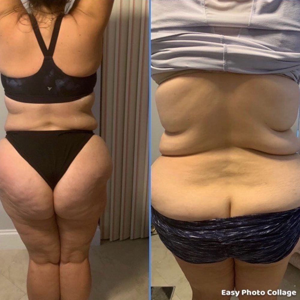 6 Session BodySculpting Package at FlawlessGlow Body Esthetics,LLC in Port St Lucie, FL