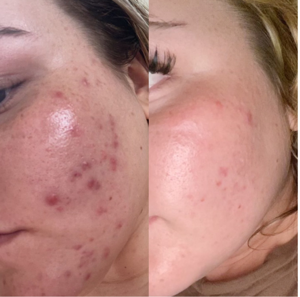 Acne Bootcamp 1st Treatment/Consult