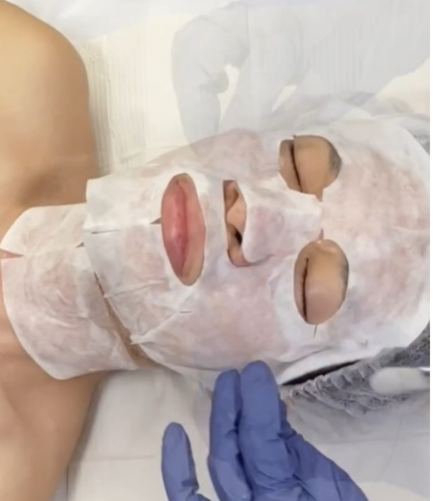Carboxy Therapy