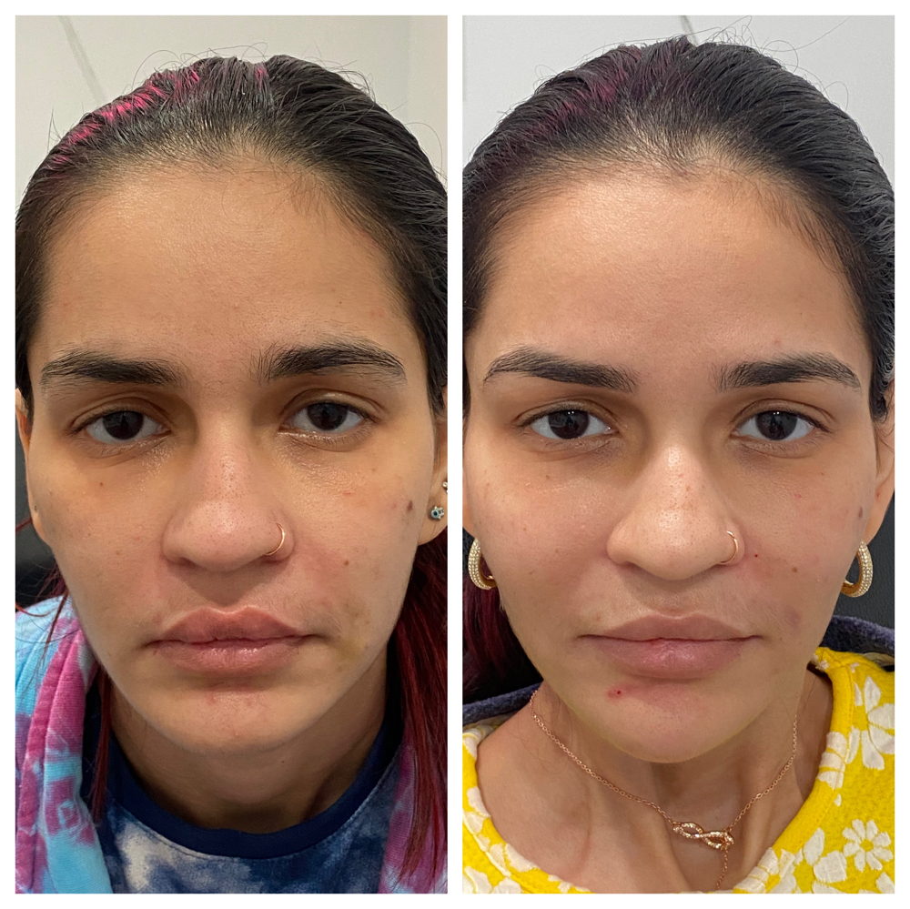 Facial Balancing at Aesthetic NP Marie in Portland, OR