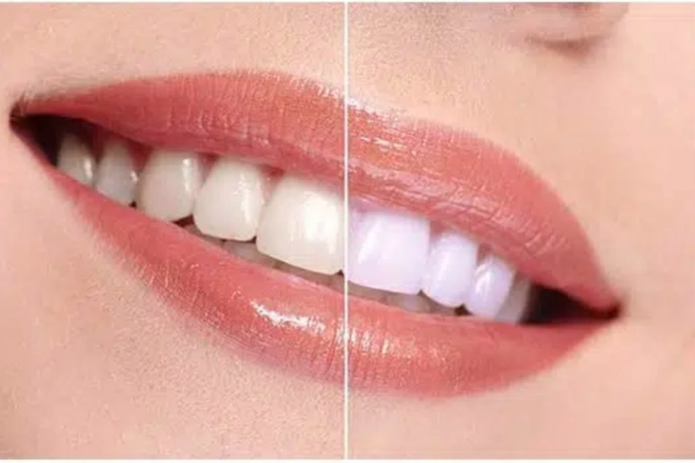 Teeth Whitening