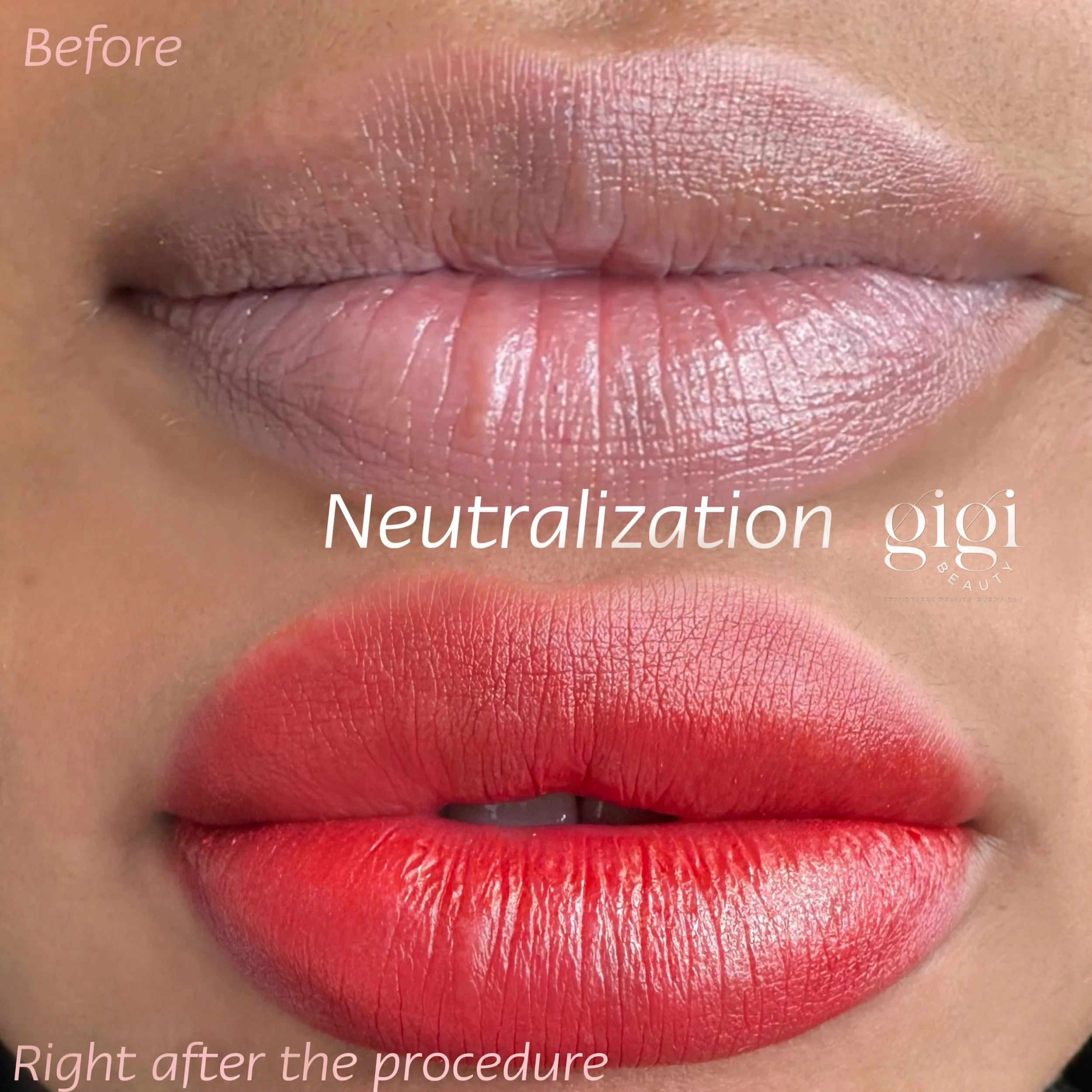 Dark Lip Neutralization