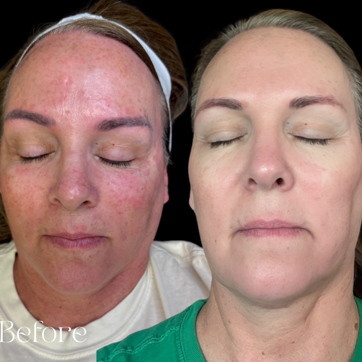 Advanced Laser Skin Treatments at Meraki Artistry in Greenwood, IN