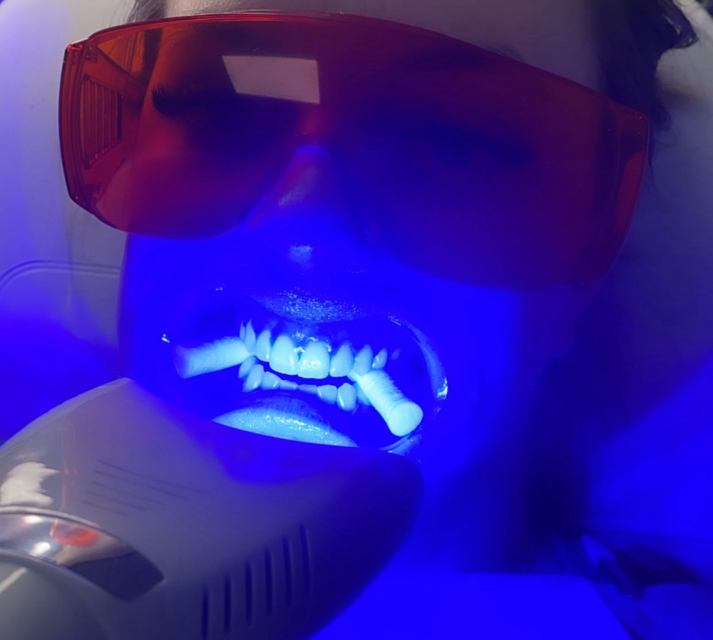 90 MIN TEETH WHITENING
