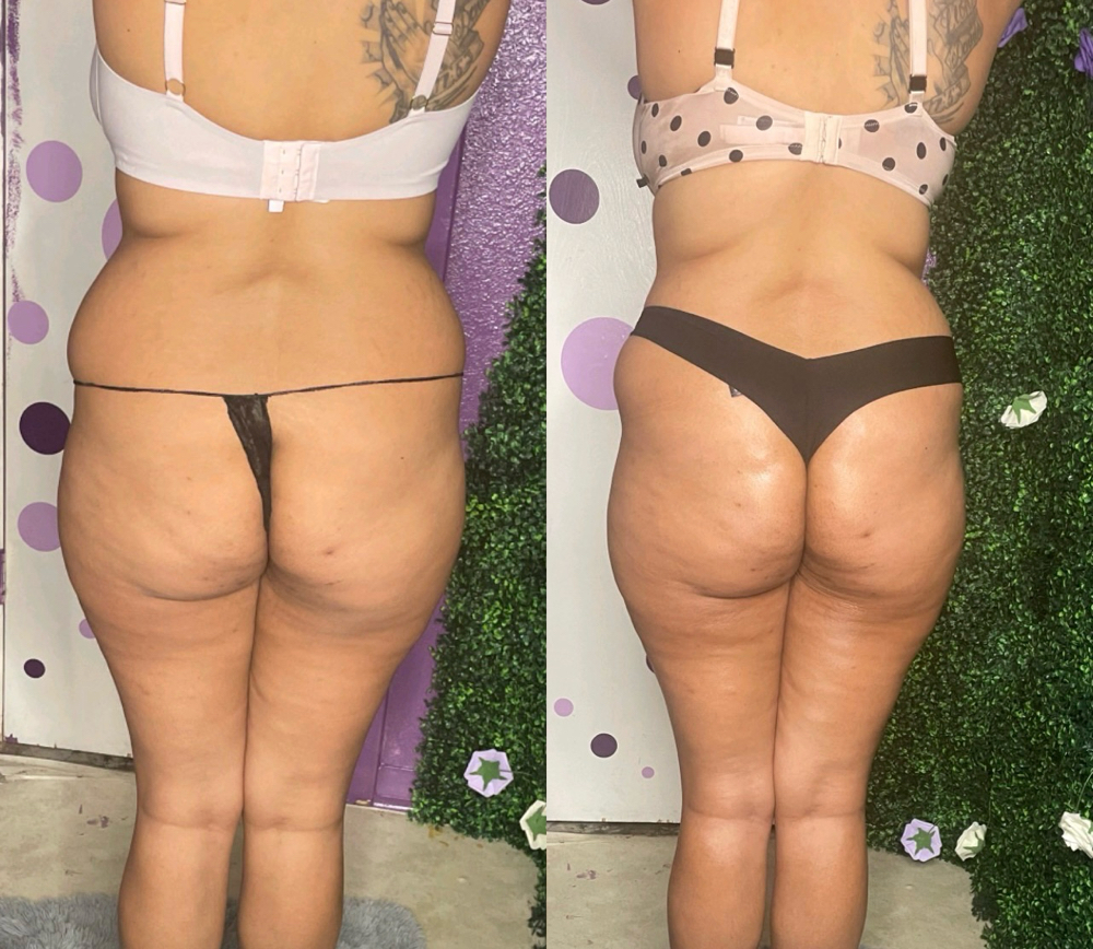 Non-Surgical Bbl 1hr