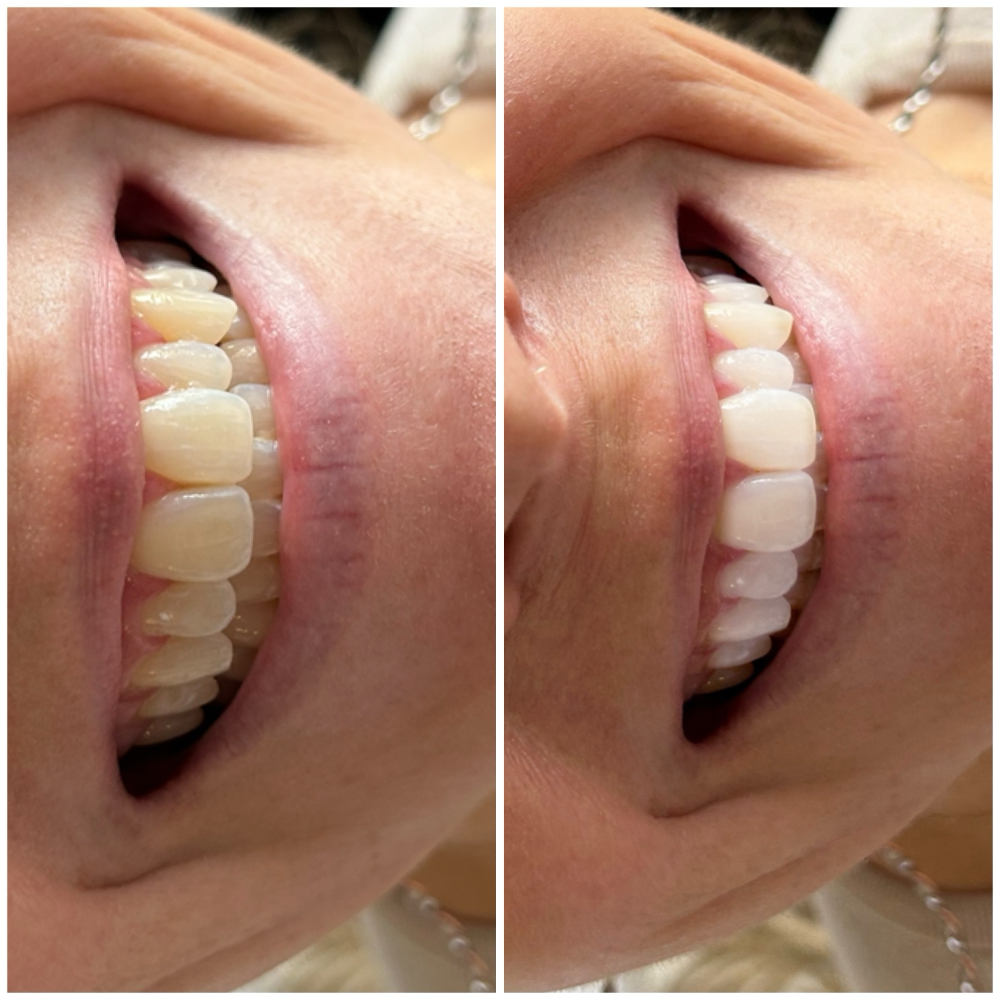 Teeth Whitening Touch Up