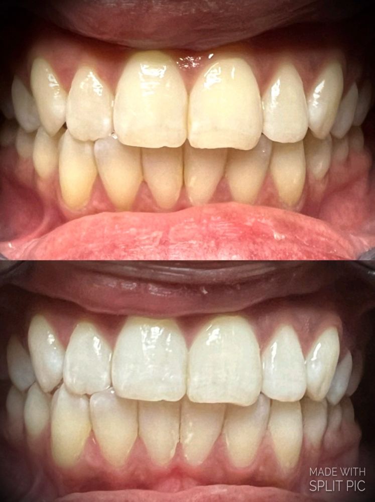 💎 Ultimate Teeth Whitening 🦷