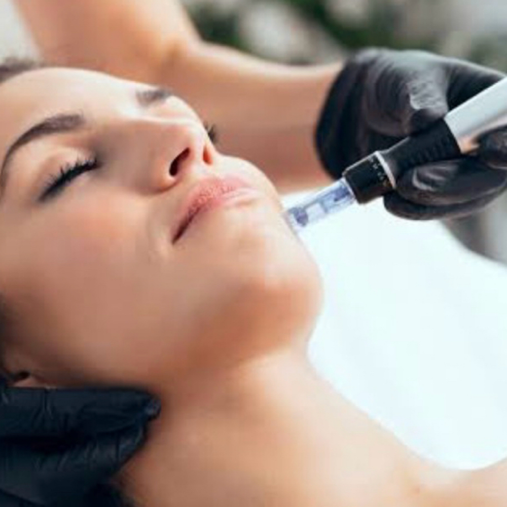 Microneedling at Joelle Beauty and Wellness in Brownsville, TX