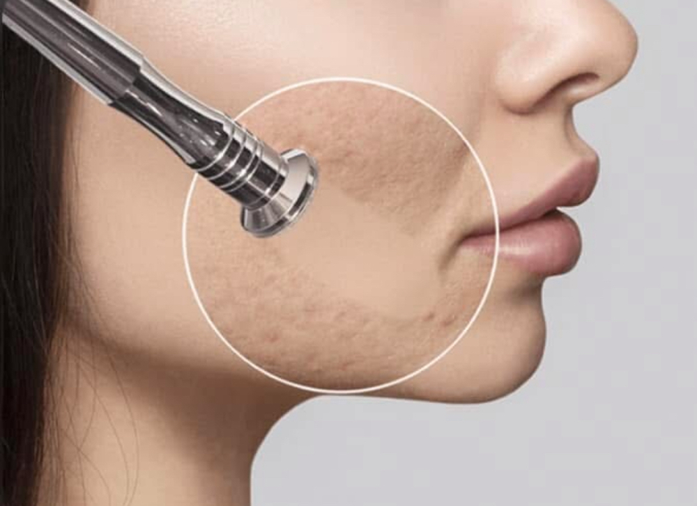 Microdermabrasion Facial