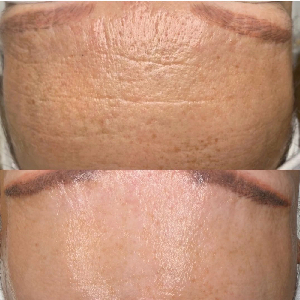 Magic Microneedling at Sanazskincenter in Vienna, VA