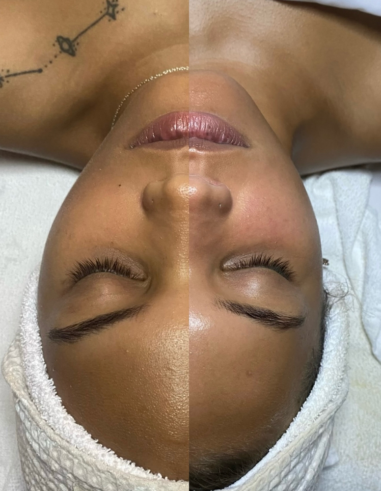 New Skin Facial