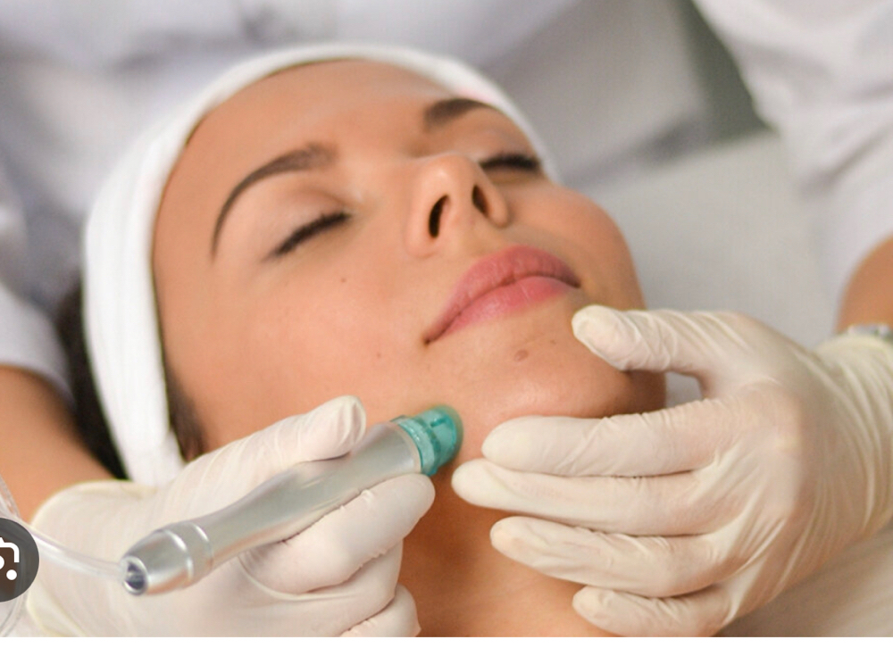 Hydro Microdermabrasion W/ TCA Peel