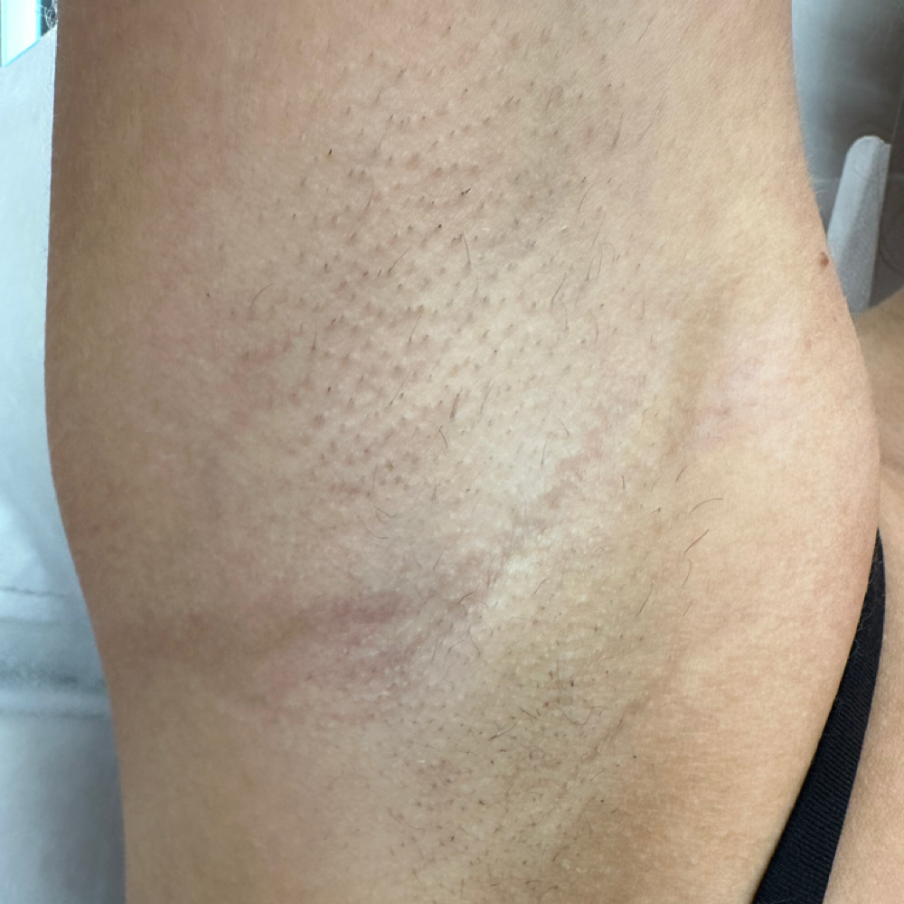 Laser Hair Removal- Underarms at Erika’s Beauty Lab in Littleton, CO