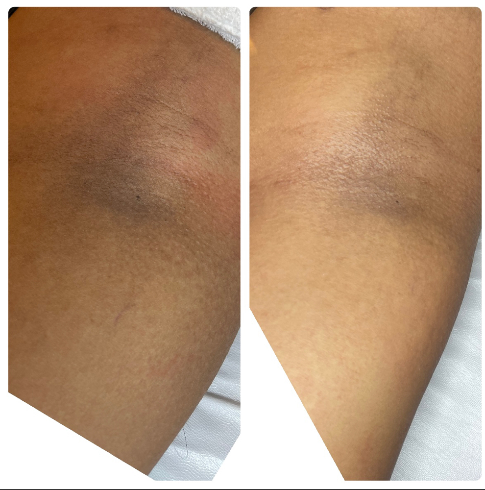 Under Arm lightening