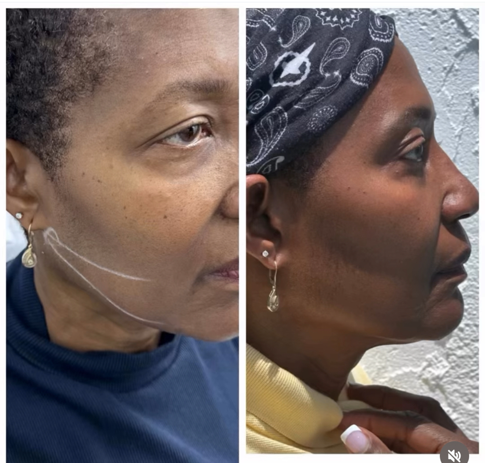 PRP Facial (Vampire) at Arewa Essential Medspa in Mamaroneck, NY