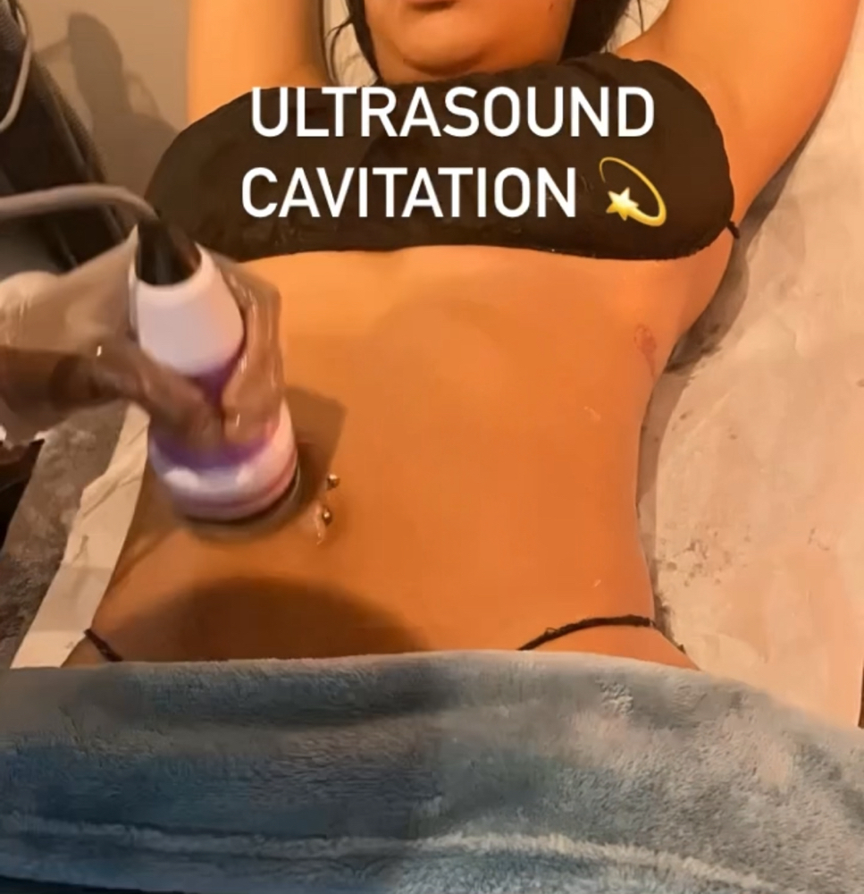 Ultrasound Cavitation