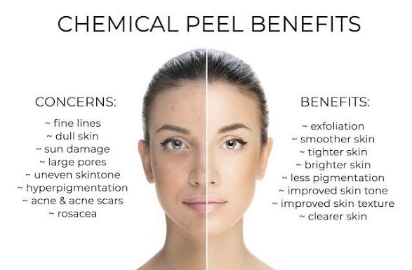 Chemical Peel