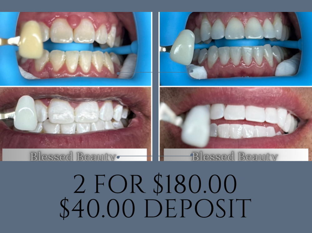 Teeth Whitening Special For 2 at Blessed Beauty in El Paso, TX