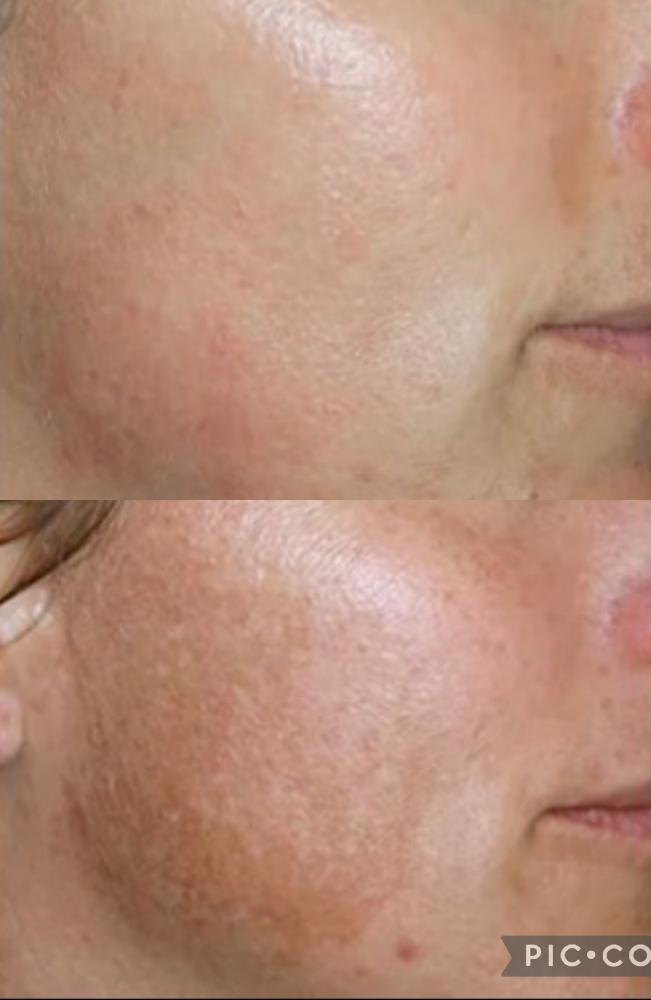 Chemical Peel