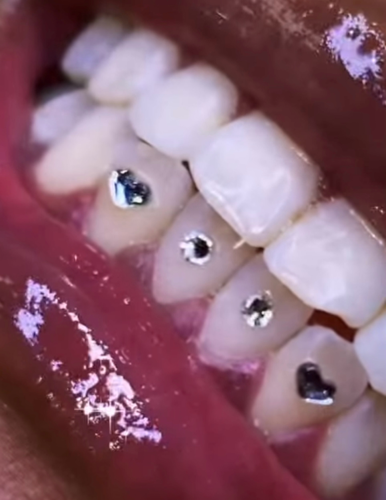 2-4 Tooth Gems