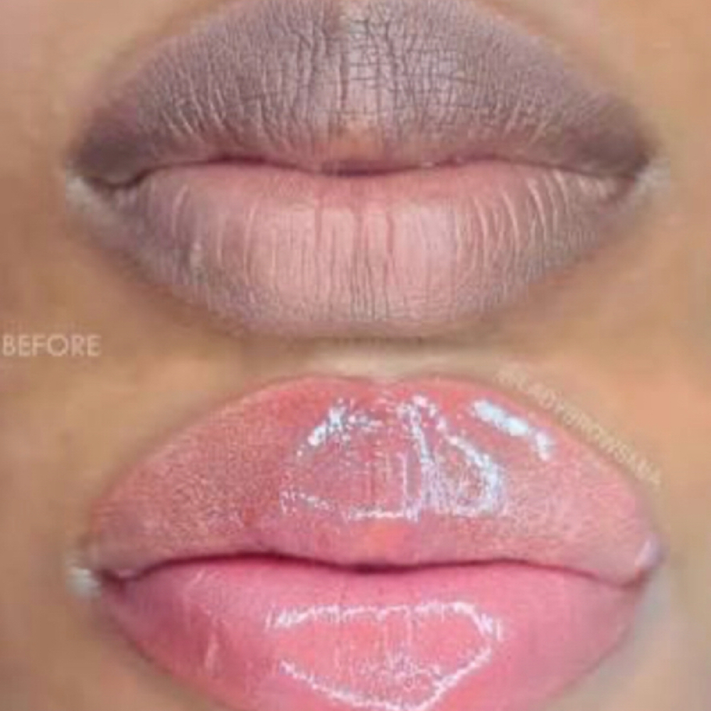 Lip Neutralization (First Session) at NAIL CARE OF PLAINFIELD in Plainfield, IL